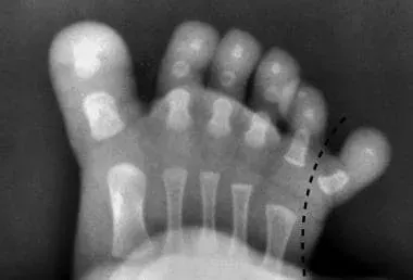 What are the symptoms of polydactyly? 