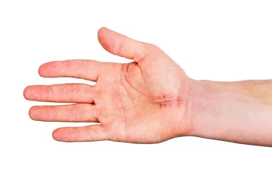 What is carpal tunnel release surgery? 