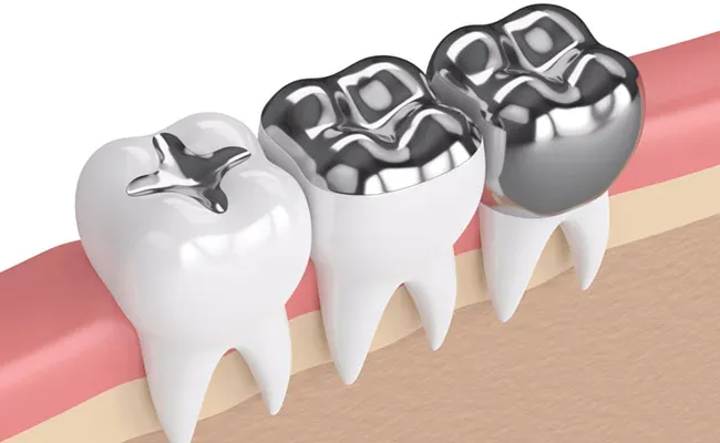 How is Dental Filling Performed? 