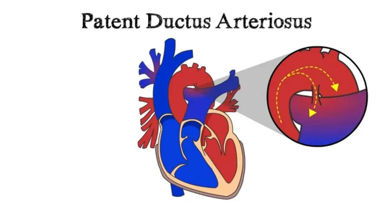 Patent Ductus Arteriosus in Iran