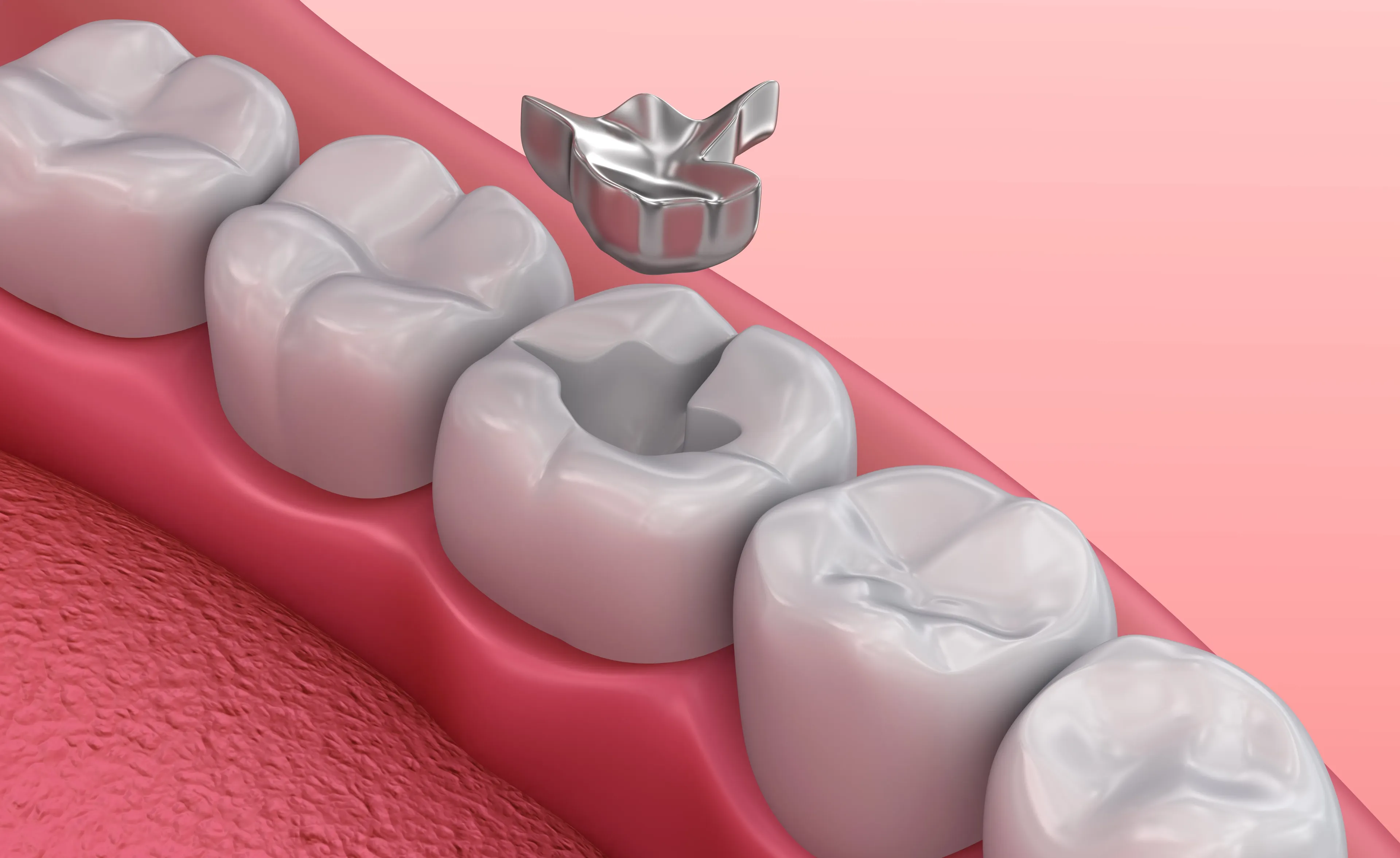 Dental Filling in Iran