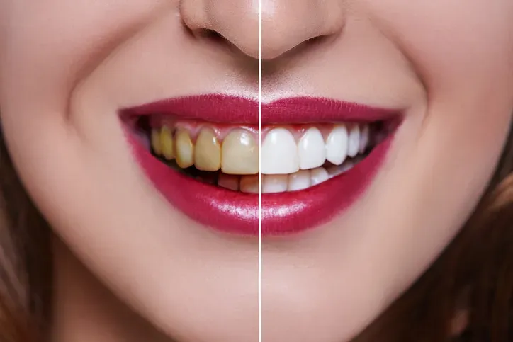 Dental Veneer in Iran