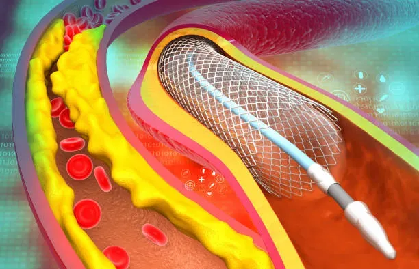 Angioplasty in Iran