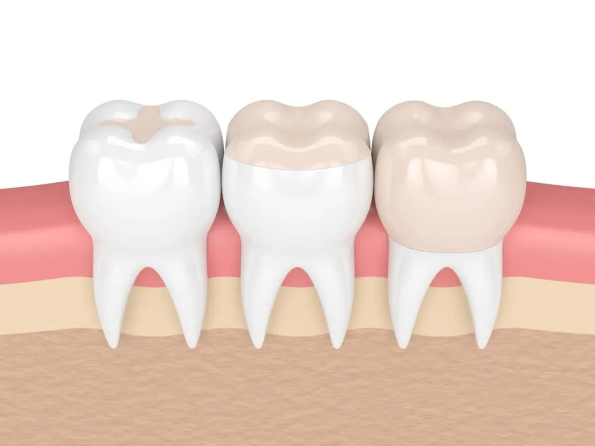 Dental Filling in Iran