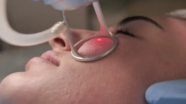 Skin laser resurfacing in Iran