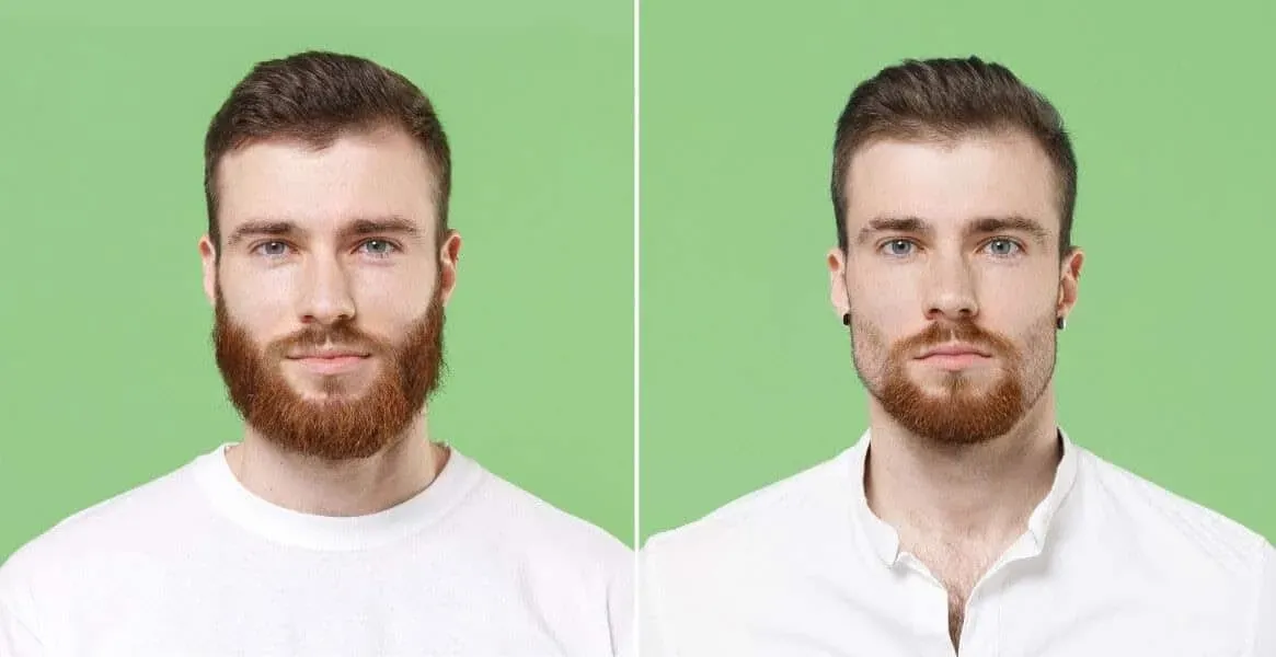 Beard Transplant candidates & aftercare