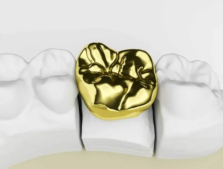 About Dental Crowns