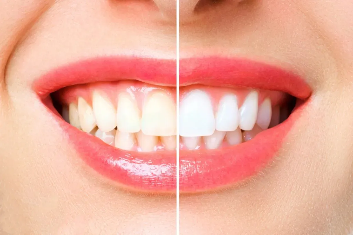 What is Teeth Whitening (Bleaching)? 