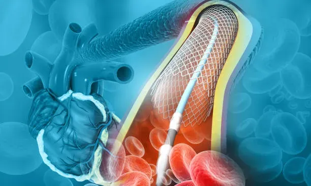 Angioplasty in Iran