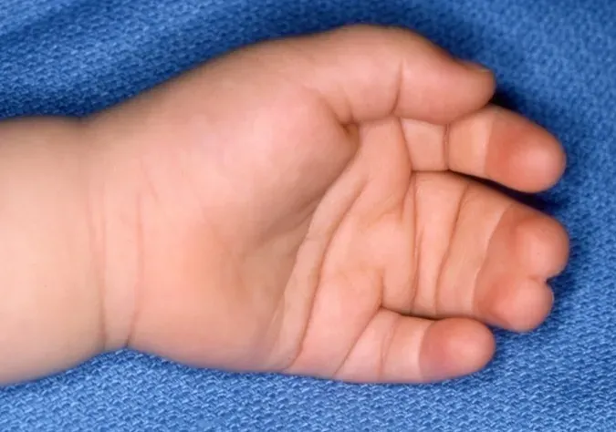 How is syndactyly treated?