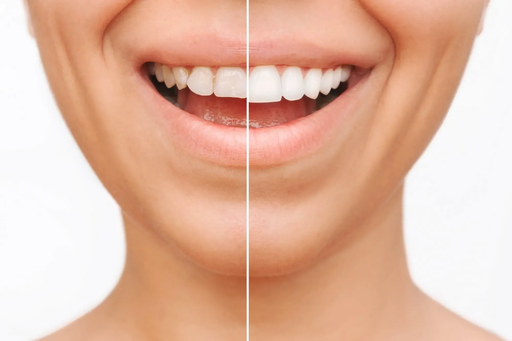 Teeth Whitening (Bleaching) in Iran