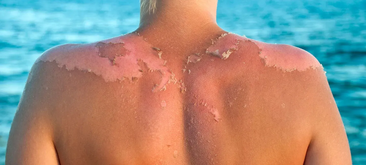 What is Skin Cancer? 