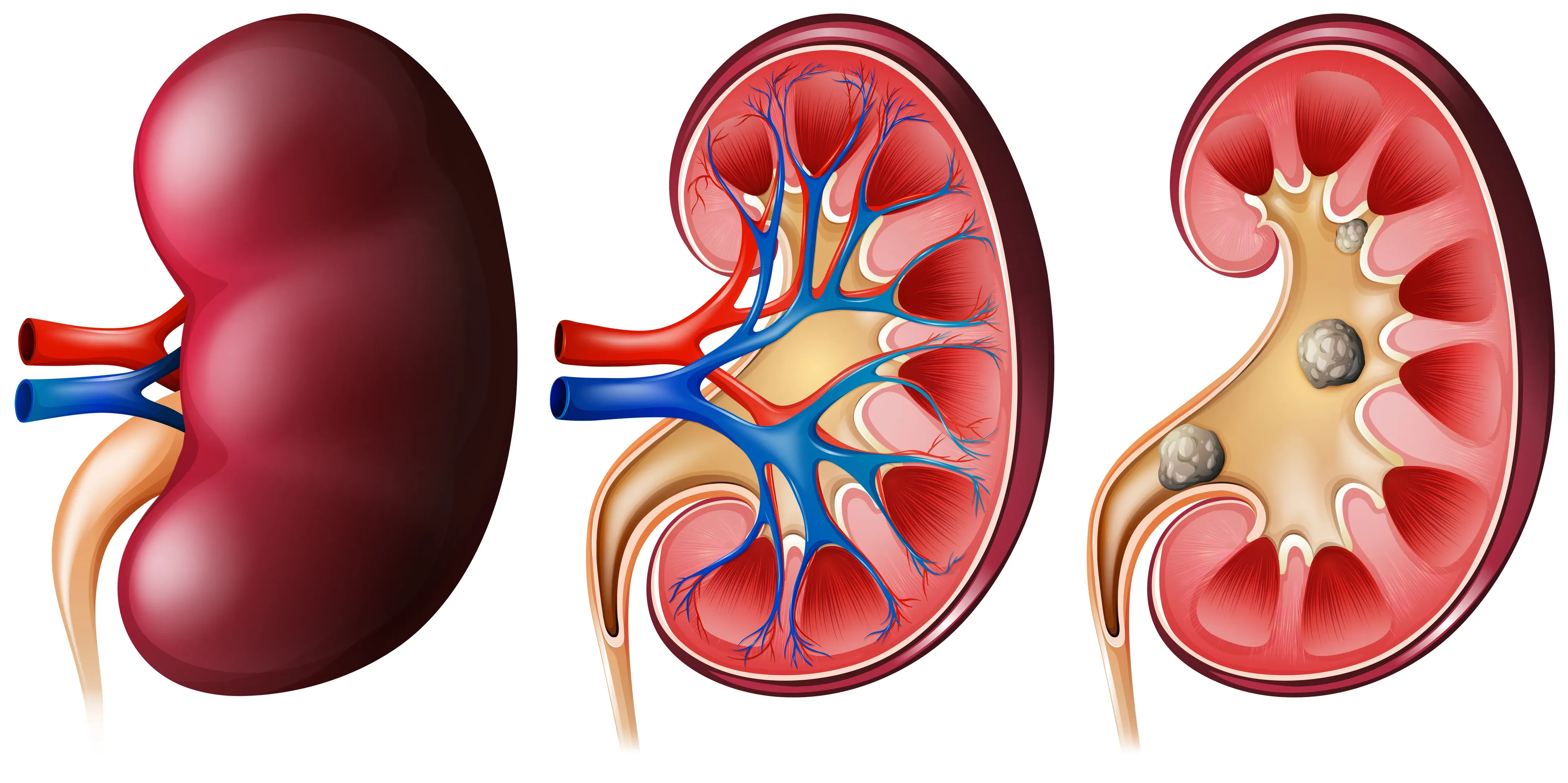 Lithotripsy in Iran