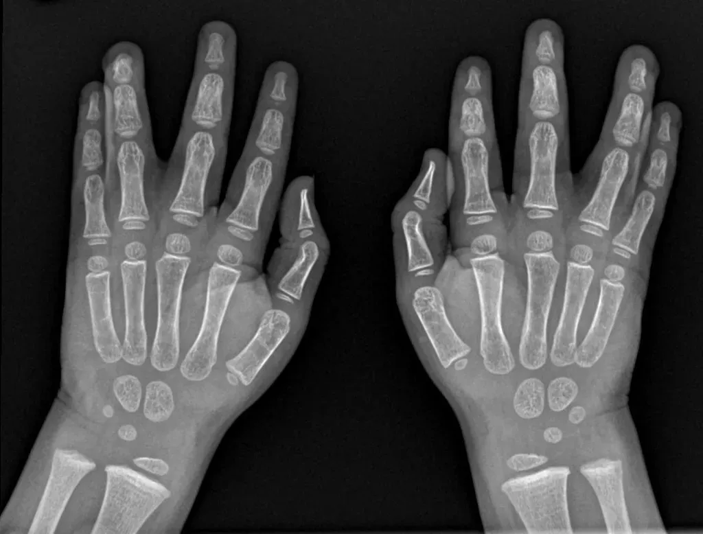 Syndactyly surgery in Iran