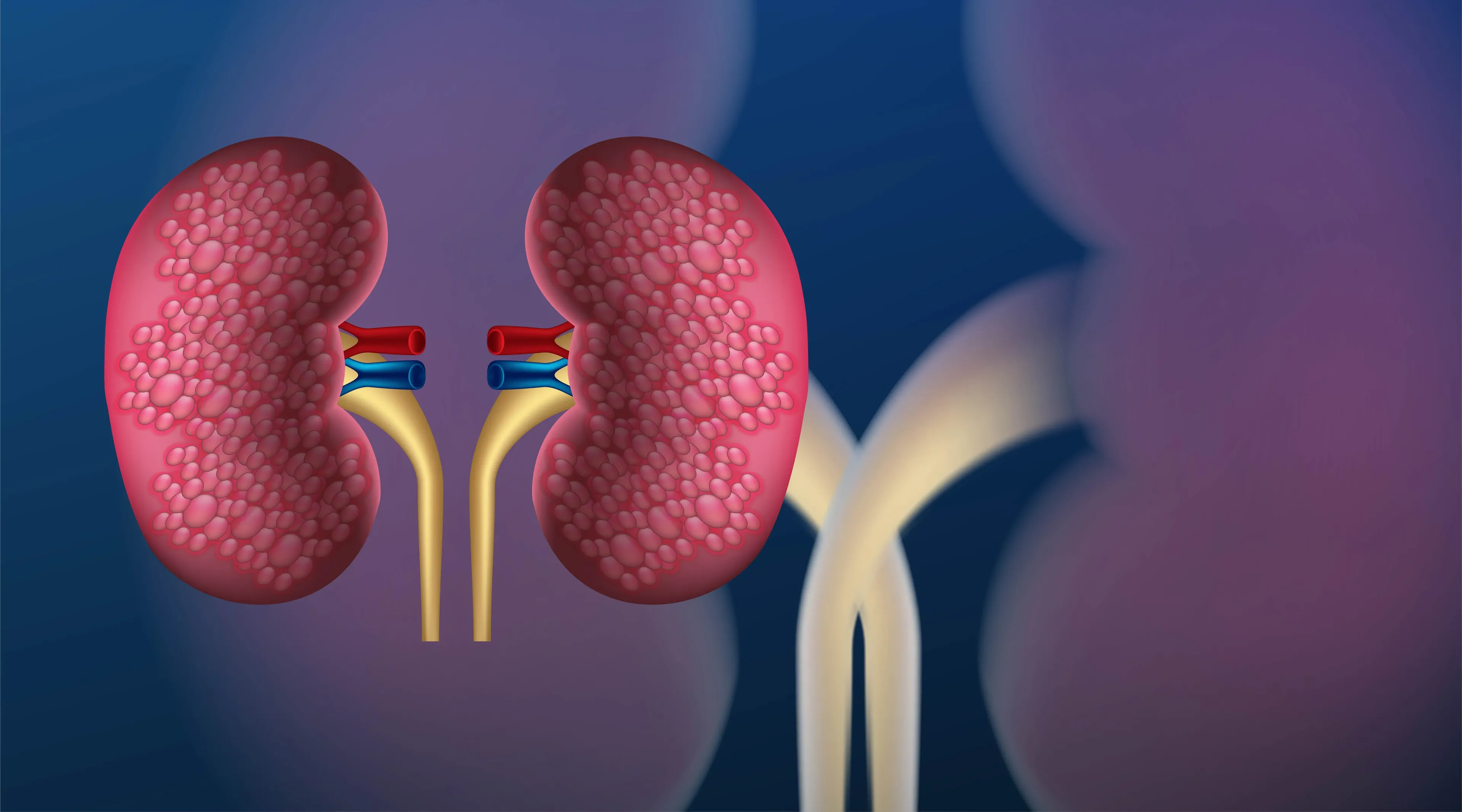 Lithotripsy in Iran