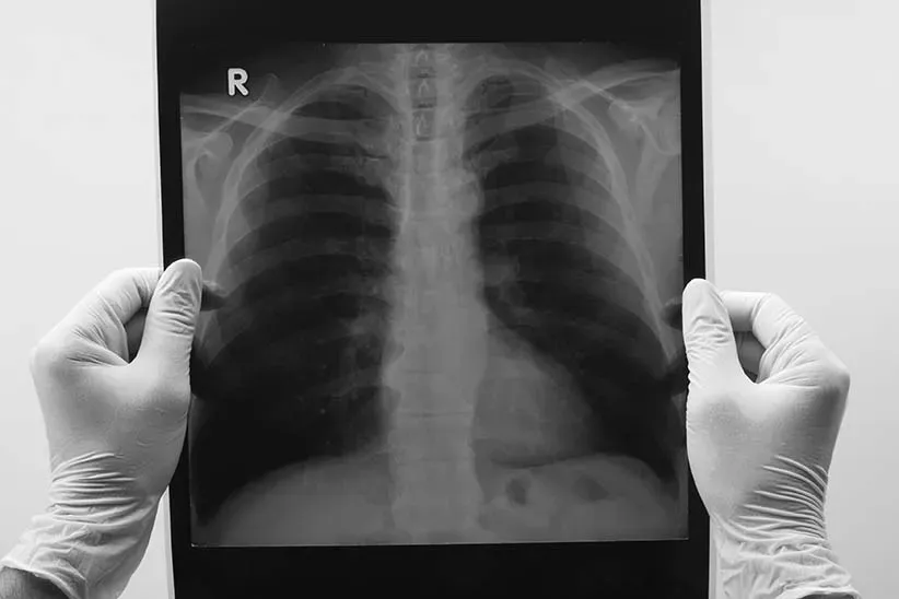 Lung Surgery in Iran