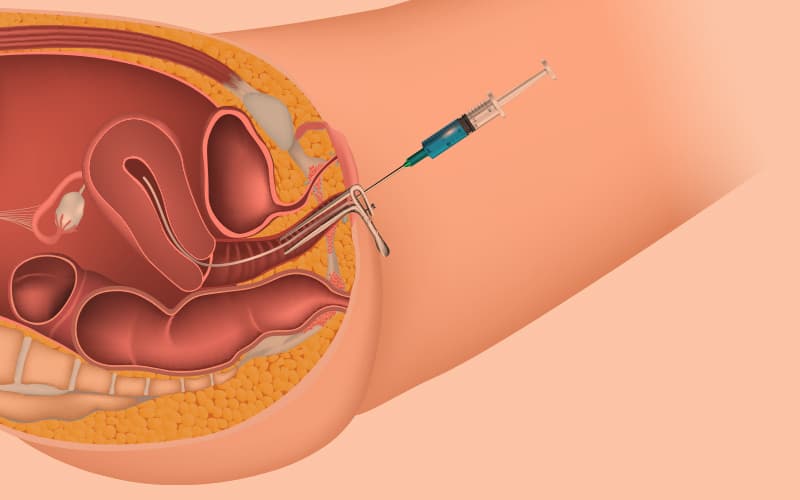 What is Artificial insemination or IUI?