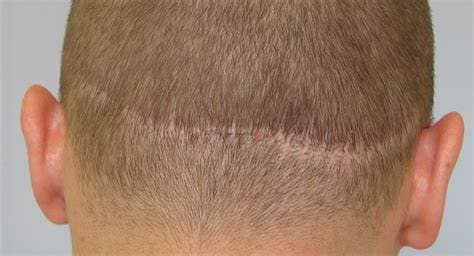 FUE vs. FUT