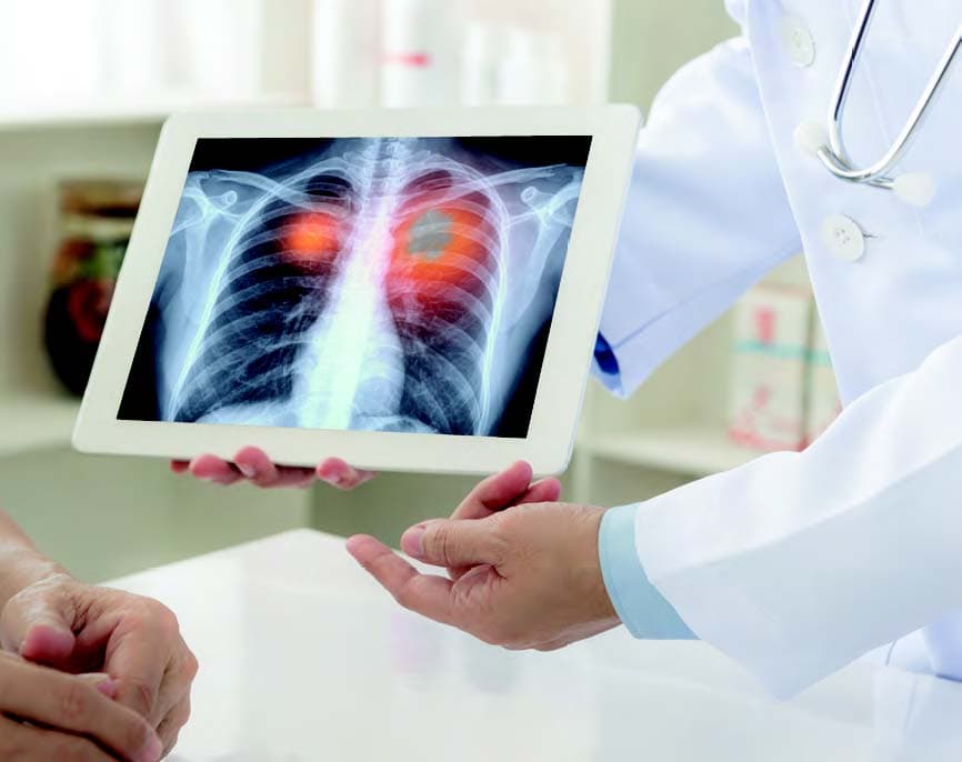 What is lung volume reduction surgery (LVRS)?