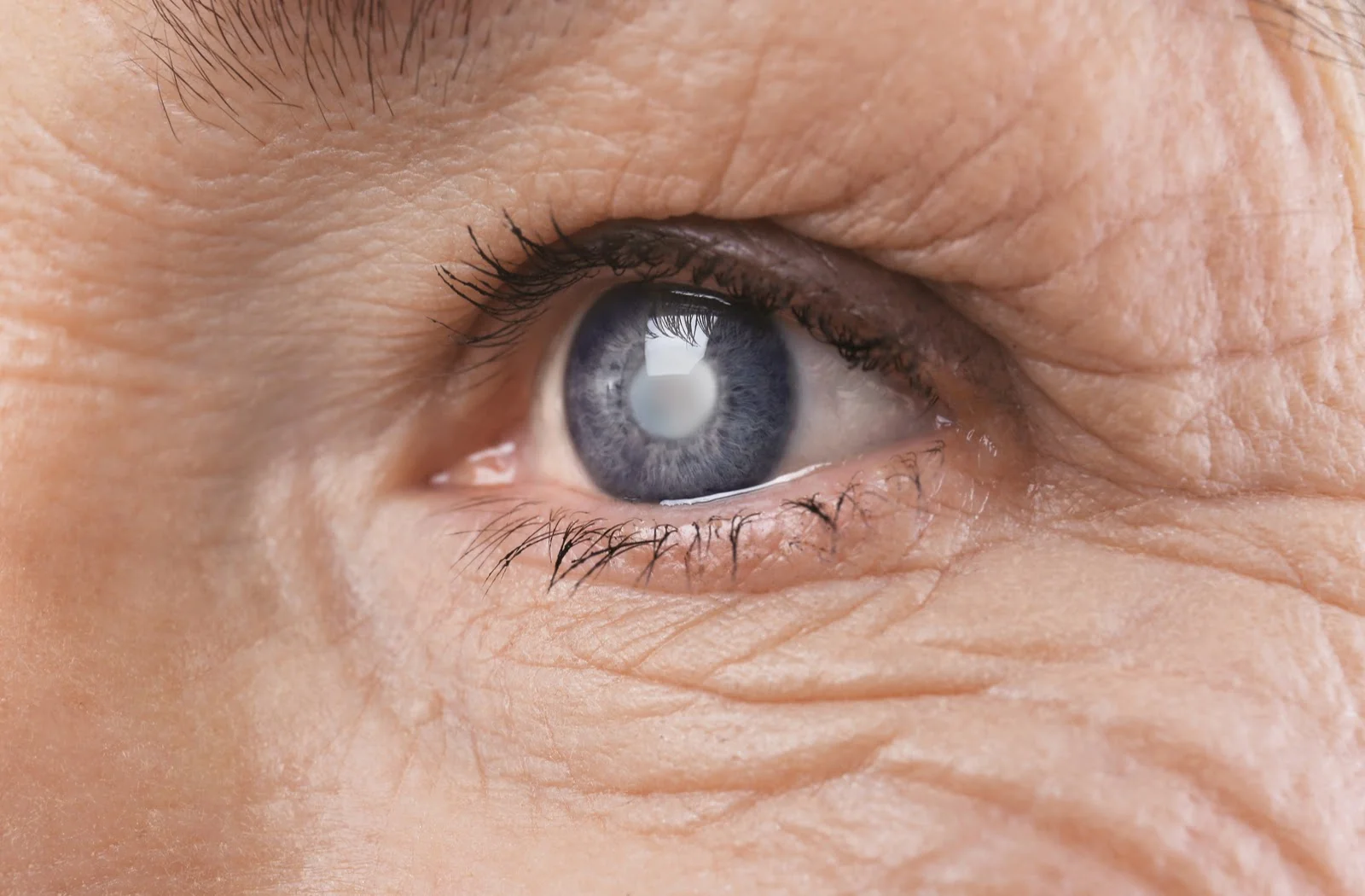 Glaucoma; Causes, Diagnosis and Treatment