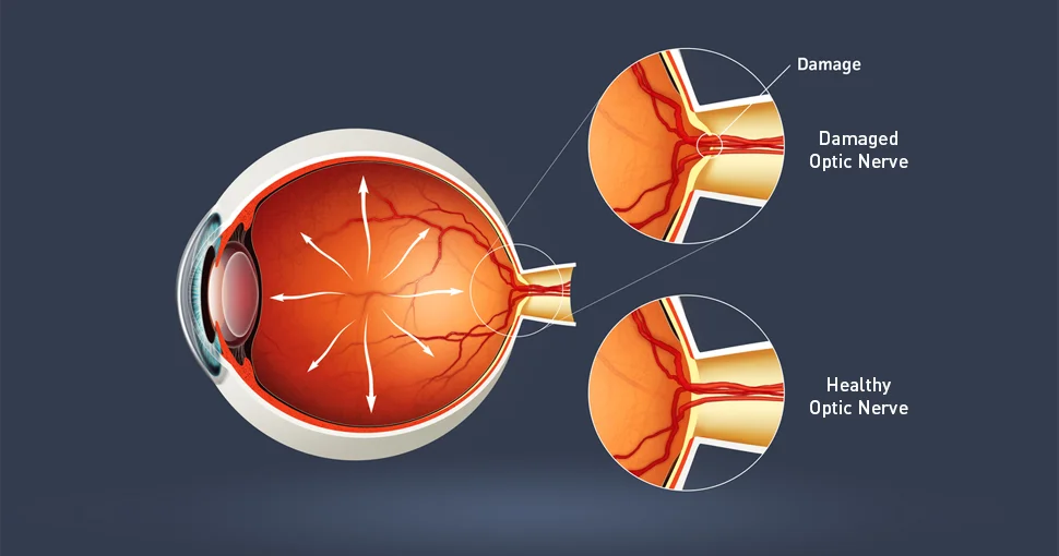 Glaucoma; Causes, Diagnosis and Treatment